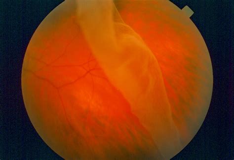 Giant Retinal Tear American Academy Of Ophthalmology
