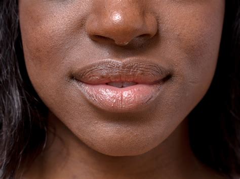 How To Get Rid Of Dry Skin Above Upper Lip