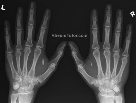 Approach To Hand X Rays · Rheumtutor