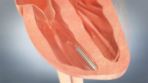 New Pacemaker Radically Changes The Way Heart Procedures Are Done