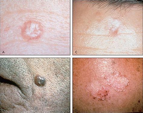 Pin On How To Get Rid Of Warts