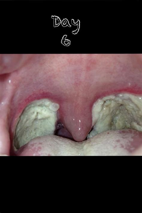 Tonsillectomy Scabs When Do They Fall Off