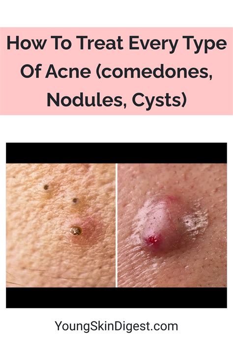 How To Treat Every Type Of Acne Comedones Nodules Cysts Young