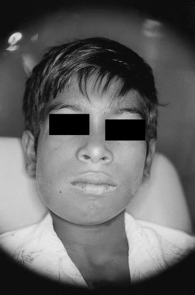 An 11 Year Old Boy Case 1 With A Diffuse Swelling Of The Right Side