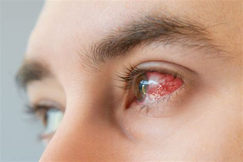 Dry Eye Disease Alters How The Eyes Cornea Heals Itself After Injury