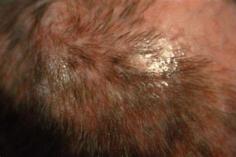 Fungal Skin Infection Tinea Corporis Cruris Pedis Capitis