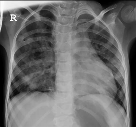 Chest X Ray Showing Bilateral Haziness In The Lung Parenchyma