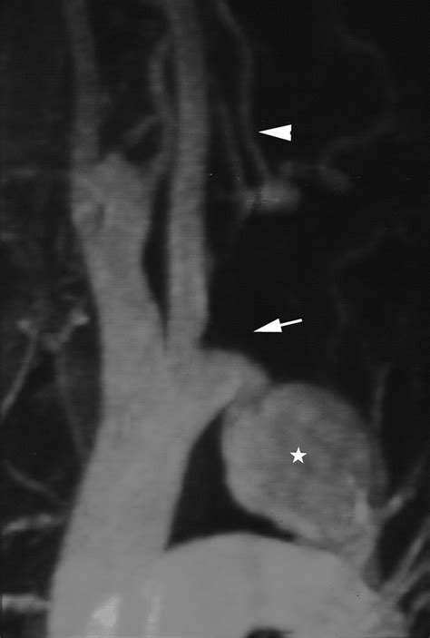 Surgical And Endovascular Repair Of Aortic Coarctation Normal Findings