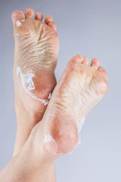Top 60 Wrinkled Soles Stock Photos Pictures And Images Istock