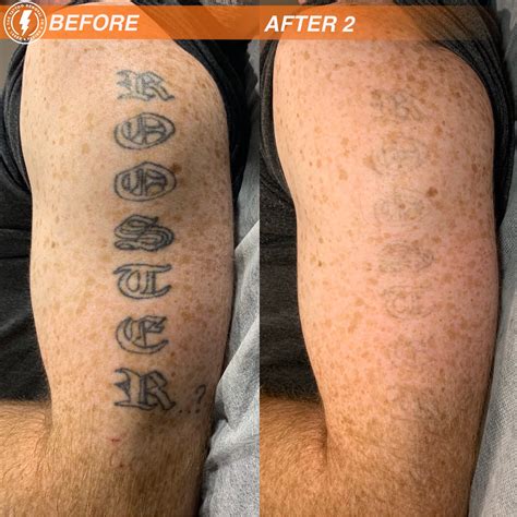 If you're interested in laser tattoo removal, the same regions of the body that are most sensitive for tattoos tend to be slightly more sensitive for tattoo removal. The Tattoo Removal Co.-Laser Tattoo Removal Adelaide ...