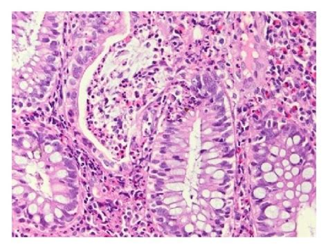 Severe Inflammation In A Patient With Active Ulcerative Colitis A