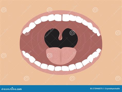 Opened Mouth Concept With Tonsils Shown Editable Clip Art Cartoon