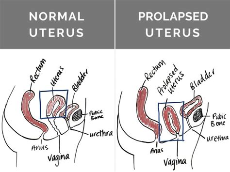 Is Surgery My Best Option For Prolapse Revitalize Physical Therapy In 2021 Pelvic Floor