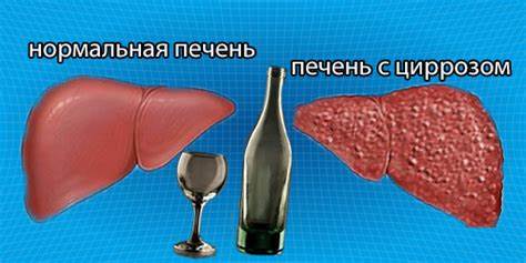 Алкогольный цирроз печени: симптомы, лечение, сколько с ним живут Картинка - Алкогольный цирроз печени: симптомы, лечение, сколько с ним живут