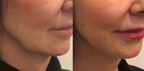 Kybella For Jowls A Game Changer U Med Spa Plano Tx