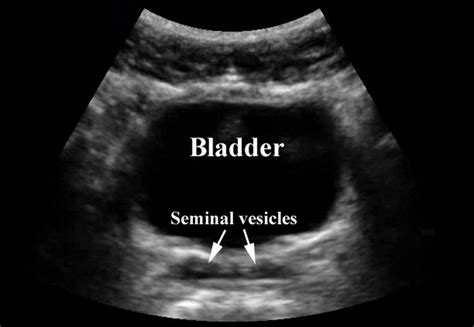 Normal Bladder Male Ultrasound Sonography Student Sonography