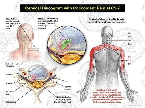 Male Right Cervical Discogram With Concordant Pain At C5 7
