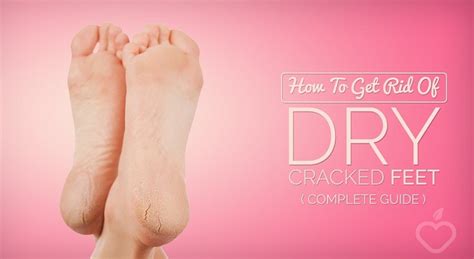 How To Get Rid Of Dry Cracked Feet Complete Guide South Florida Reporter