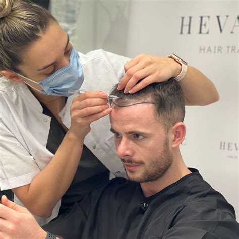 U FUE Unshaven Hair Transplant Turkey Costs In 2023 Heva Clinic
