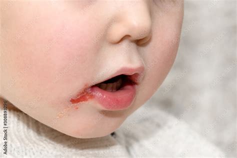 Herpes On Upper Lip Of A Little Girl Wound On The Face Of A Schoolboy