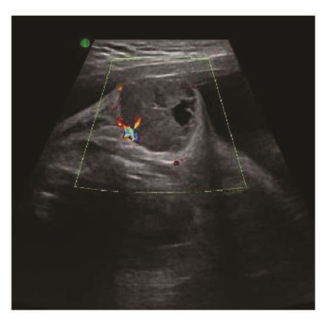 Fetal Ultrasound Showing The Tumor In The Left Armpit Download