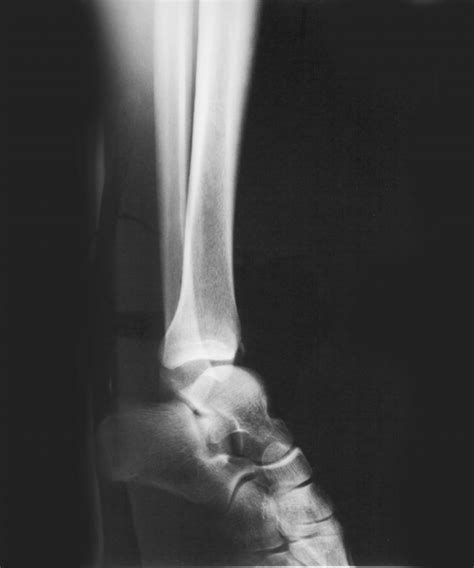 Ankle Dislocationno Fracture Copy