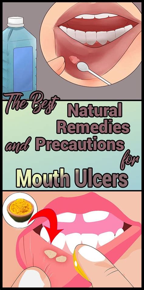 The Best Natural Remedies And Precautions For Mouth Ulcers Mouth Ulcers