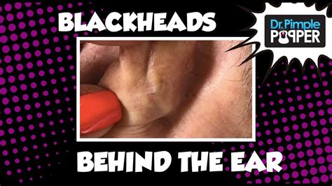 Blackheads Plus Biggest Blackhead Behind Ear Throwback Youtube