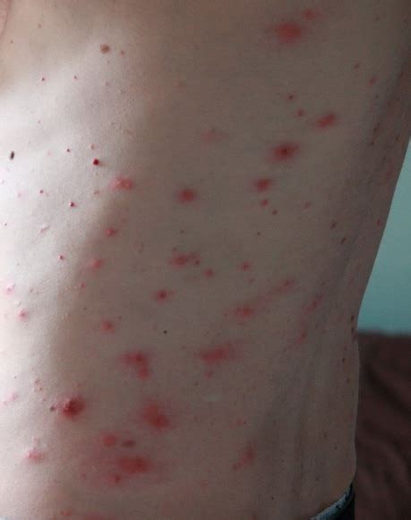 Where Do Chiggers Live Everything You Need To Know
