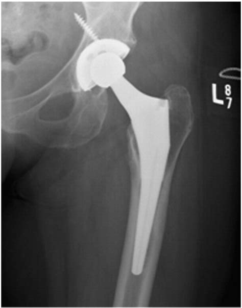 Iliopsoas Tendonitis Due To The Protrusion Of An Acetabular Component