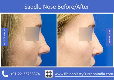 Saddle Nose Deformity Causes Rhinoplasty Surgeon India