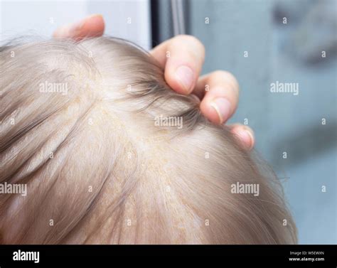 Seborrhea Baby Hi Res Stock Photography And Images Alamy