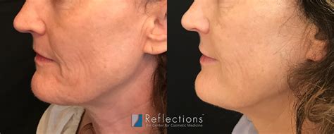 Silhouette Instalift Thread Lift Results For Woman Approaching 60 Years