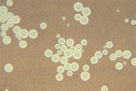 Cryptococcus Gattii Infection Storymd