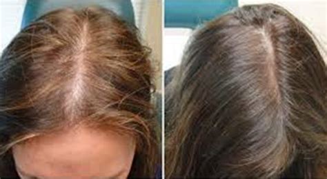 علاج تساقط الشعر عند النساء بالقران