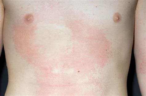 Urticaria Rash Photograph By Dr P Marazziscience Photo Library