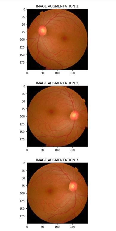 Blindness Detection Diabetic Retinopathy Using Deep Learning On Eye