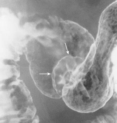 Benign Tumors Of The Stomach And Duodenum Radiology Key