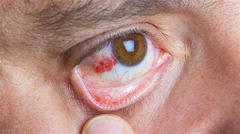 Is Conjunctivitis A Symptom Of Covid 19 Heres All You Need To Know