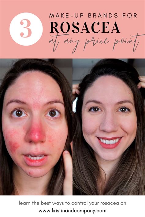 Make Up Bei Rosacea Captions More