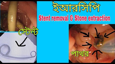 Stent Removal Stone Extraction DR MASFIQUE ERCP TOP ENDOSCOPY