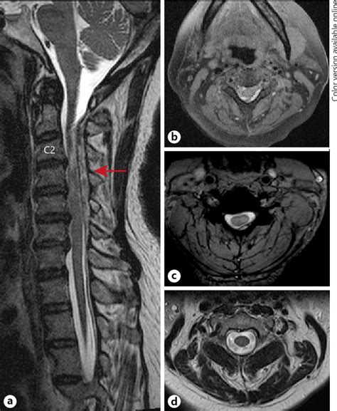 Figure 1 From Spontaneous Spinal Epidural Hematoma Mimicking Stroke And