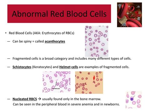 Ppt Abnormal Blood Cell Morphology Powerpoint Presentation Free