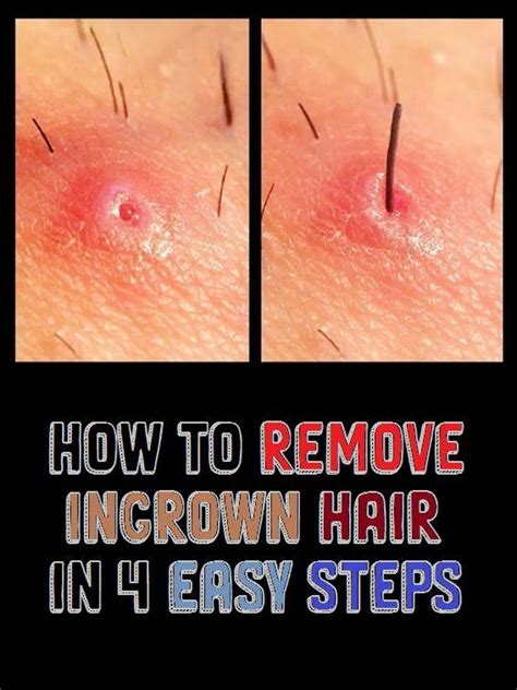 How To Remove Ingrown Hair In 4 Easy Steps Ingrown Hair Removal Ingrown Hair Ingrown Hair