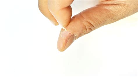 Top 81 How To Remove Nail Scratch Marks From Skin Architectures