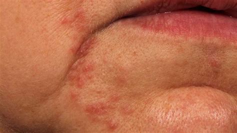 What Causes Small Pimples On The Lips