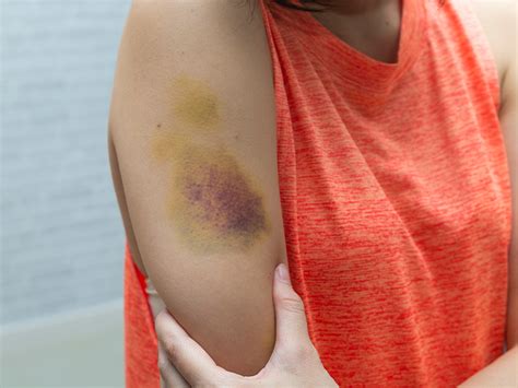Bruise Itch Causes Risk Factors And Treatment