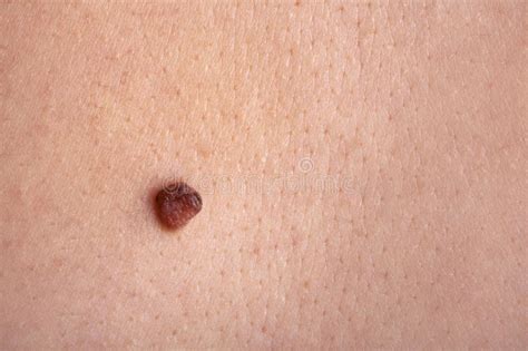 Mole On The Skin Stock Photo Image Of Women Medicine 22988610