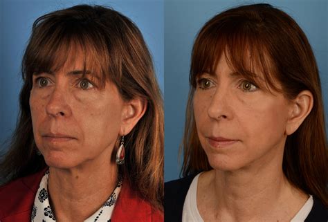 facelift neck lift before and after pictures case 169 toronto on ford plastic surgery dr