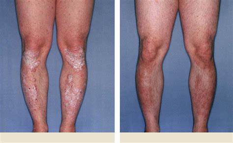 Plaque Psoriasis Pictures Before After HUMIRA Adalimumab